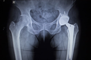 Broken Hip 2