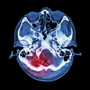 30. Cerebral Hypoxia1