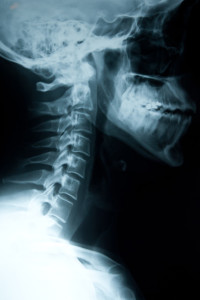 Broken Neck from a Car Accident 1